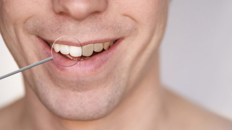 teeth whitening is it safe