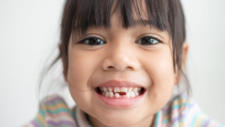 hypodontia before and after
