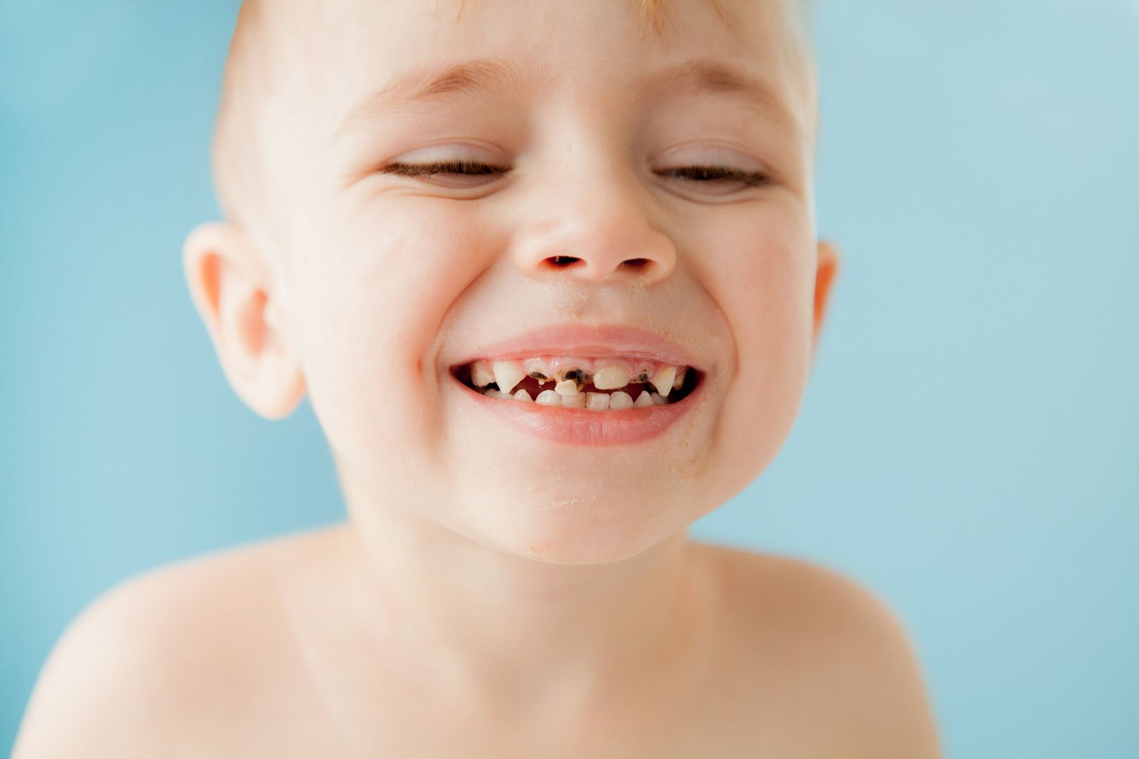 preventing tooth decay in children