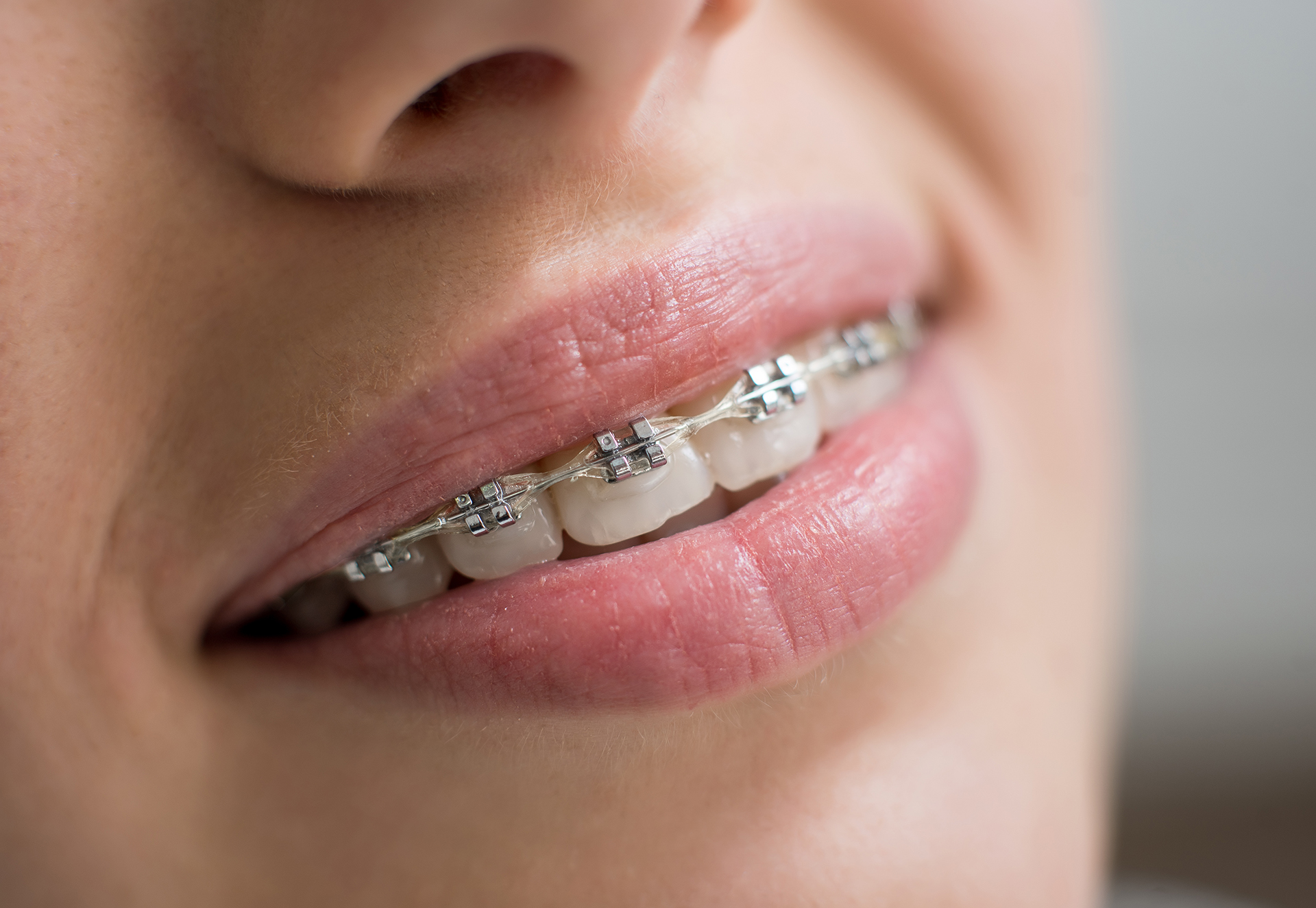 Fixed orthodontic braces in Singapore