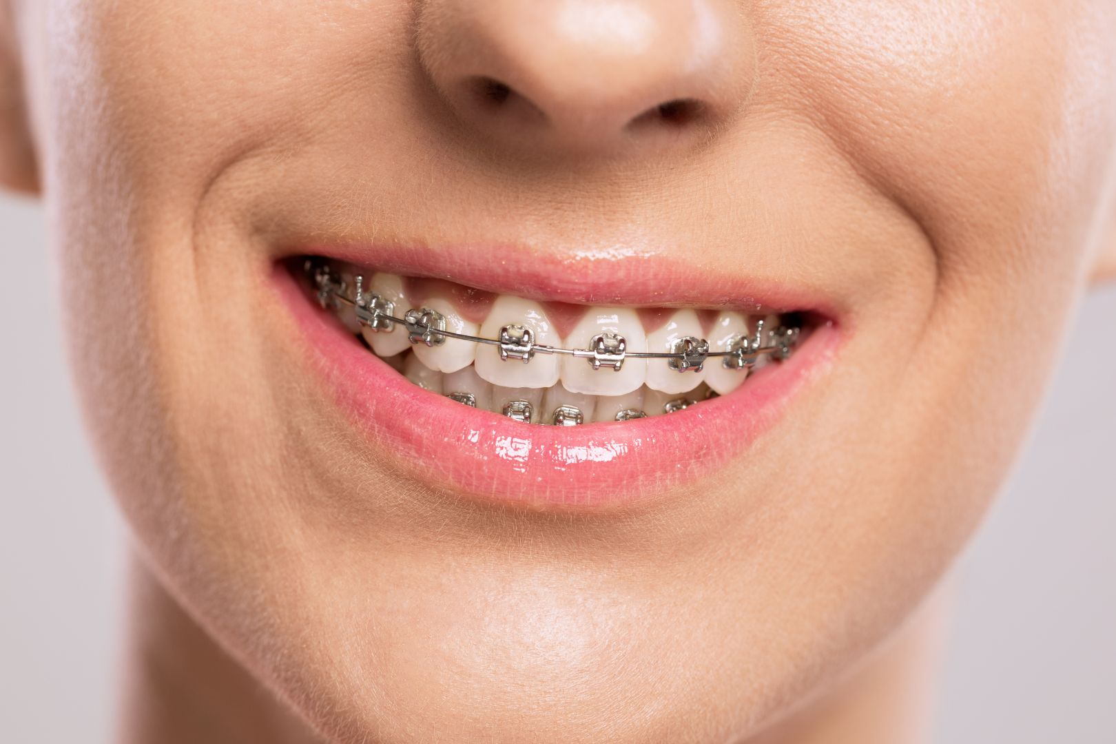 Metal Braces in Singapore: Cost, Timeline & Treatment