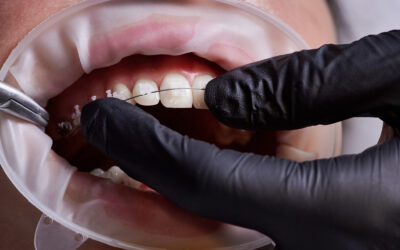 Can Braces Fix Bruxism (Teeth Grinding)?