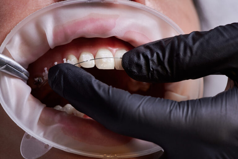 can braces fix bruxism
