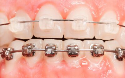 Ceramic Braces vs Metal Braces: Which Is Right for You?