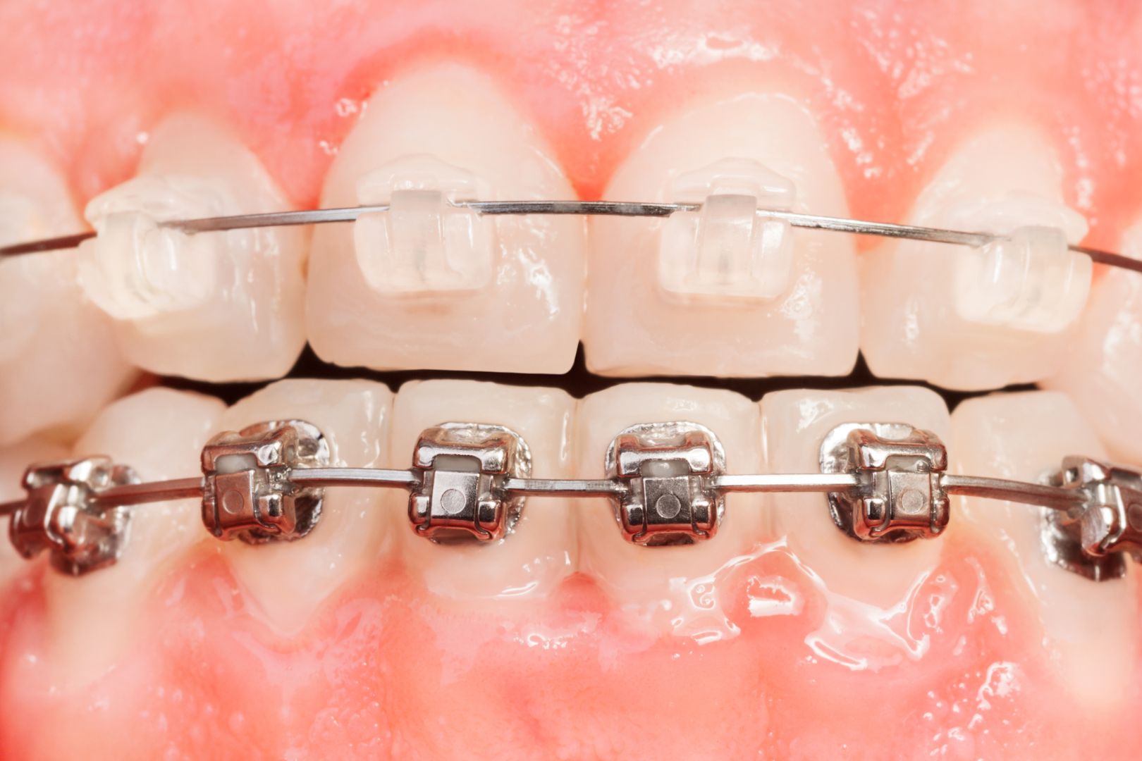 metal or ceramic braces