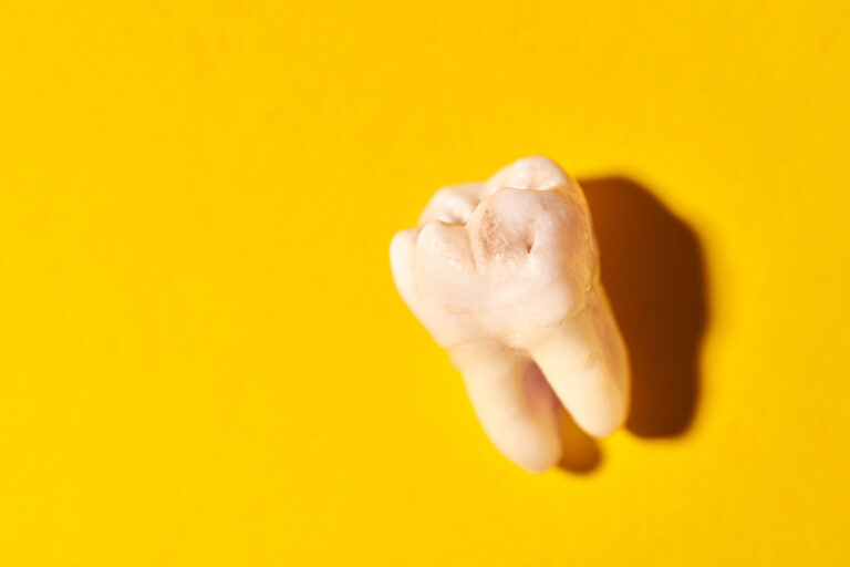 molar tooth extraction