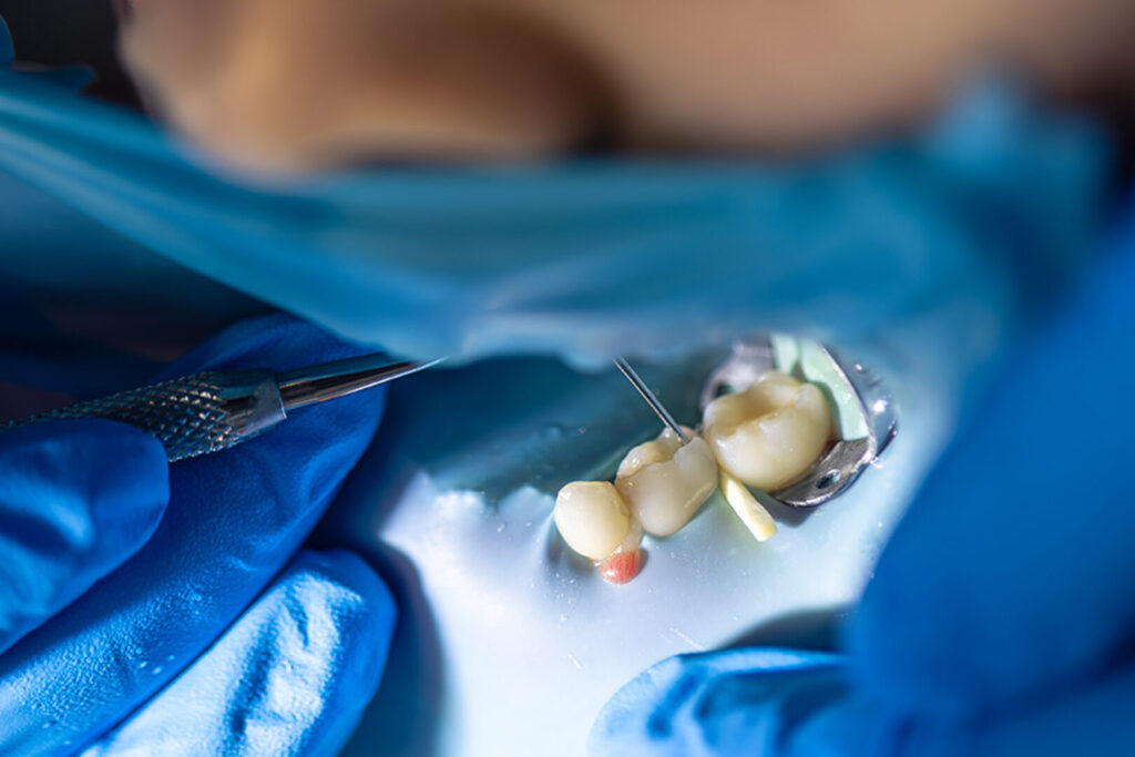 molar tooth extraction Singapore