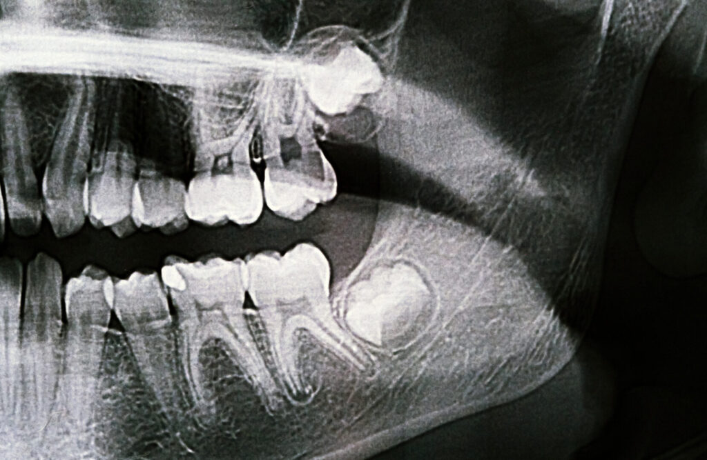 molar tooth extraction cost