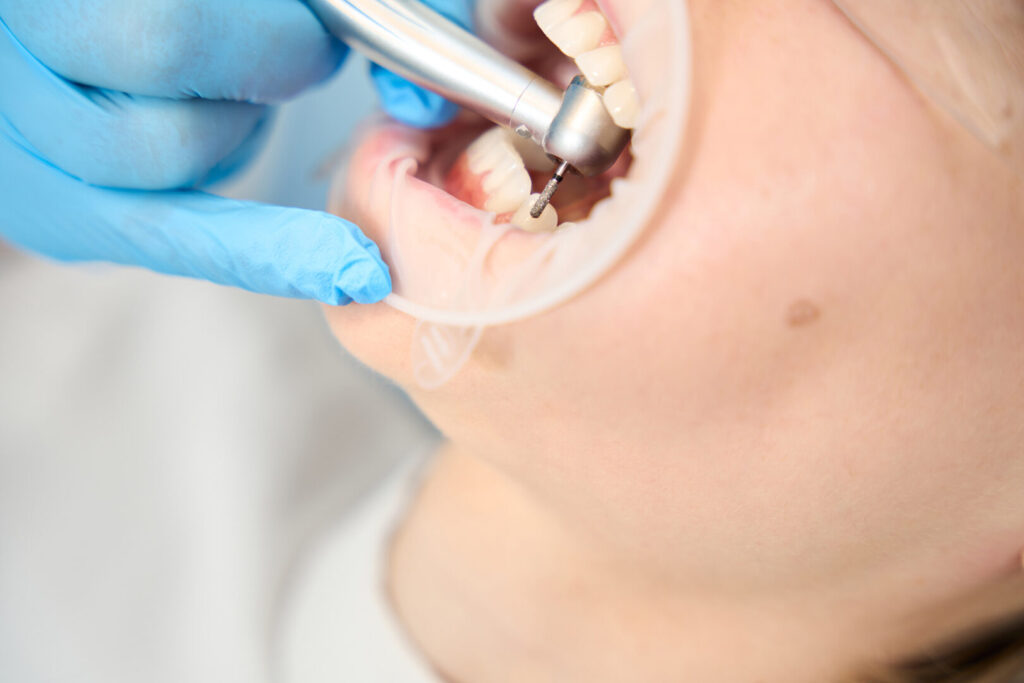 molar tooth extraction