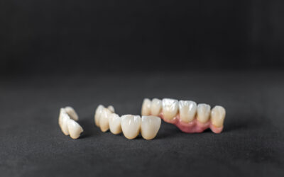 Tooth Bridges Procedure, Benefits and Cost in Singapore