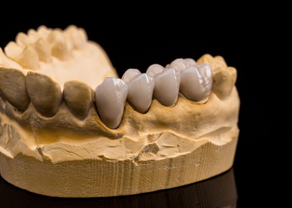 tooth bridge vs implant