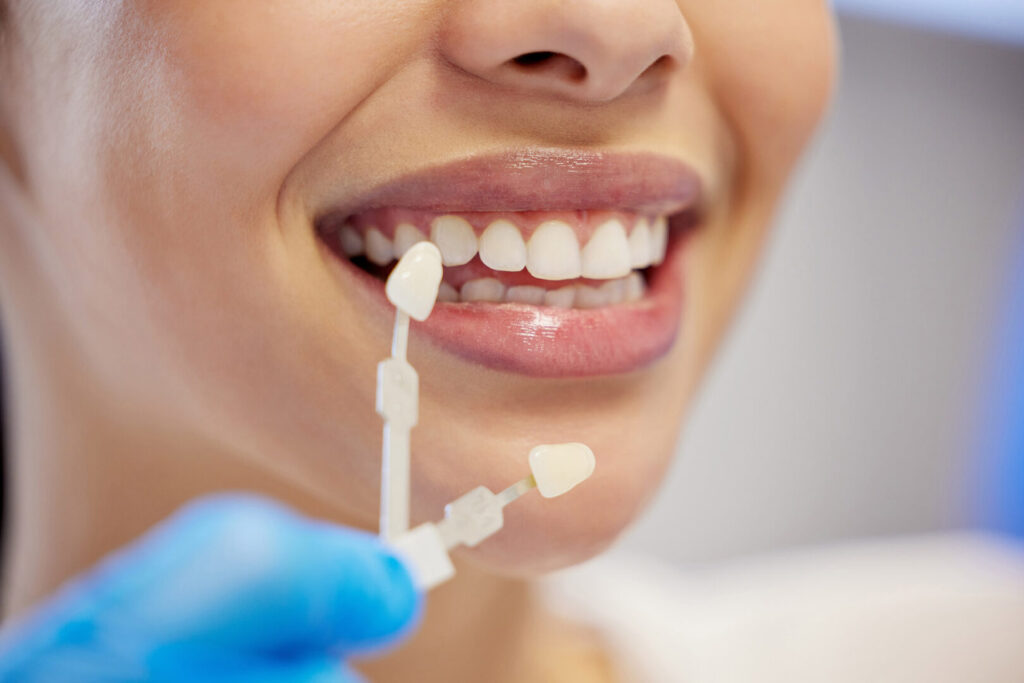 are composite veneers reversible