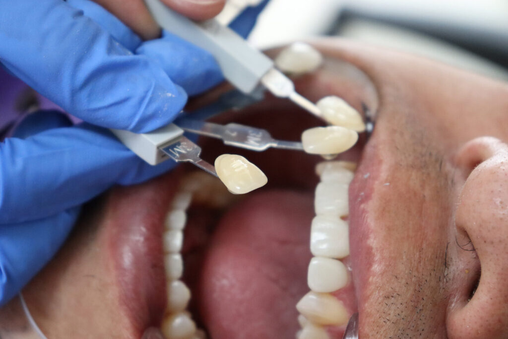 composite veneers cost Singapore
