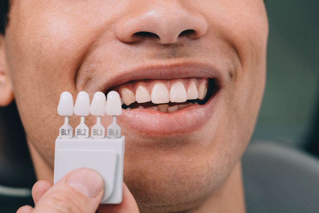 do composite veneers stain