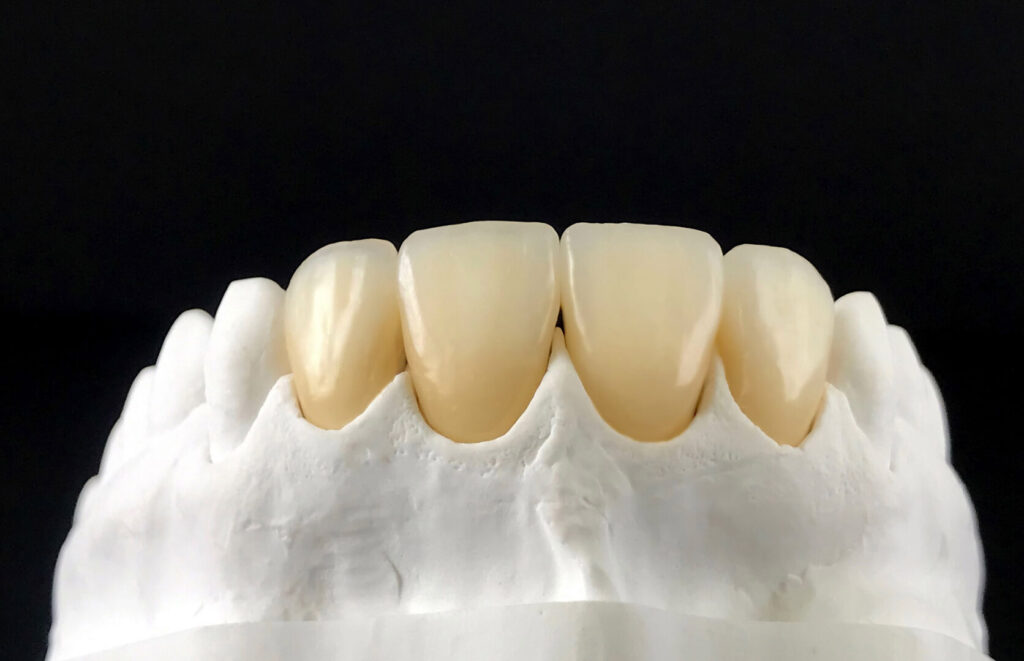 porcelain veneers price