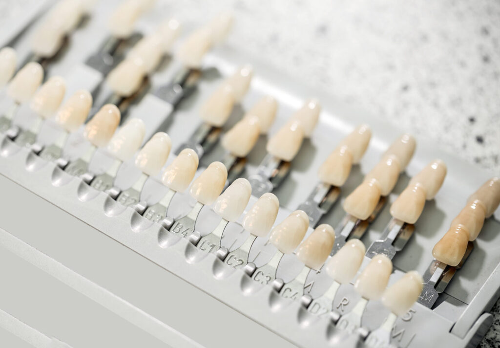 what are composite veneers