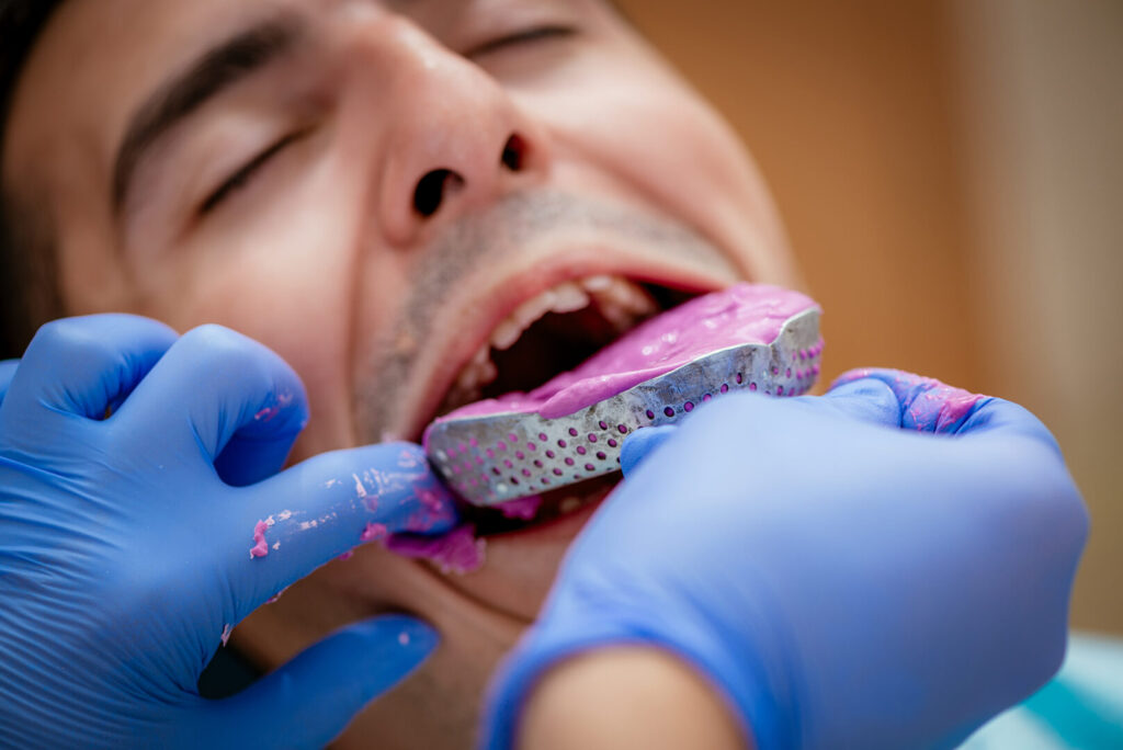 dental implant full mouth