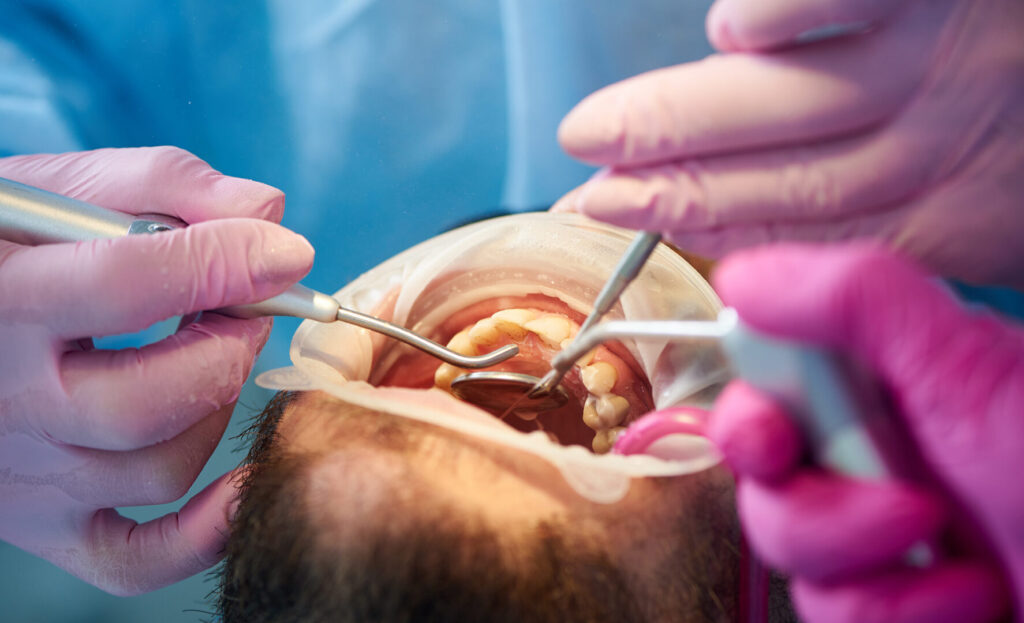 root canal treatment cost Singapore