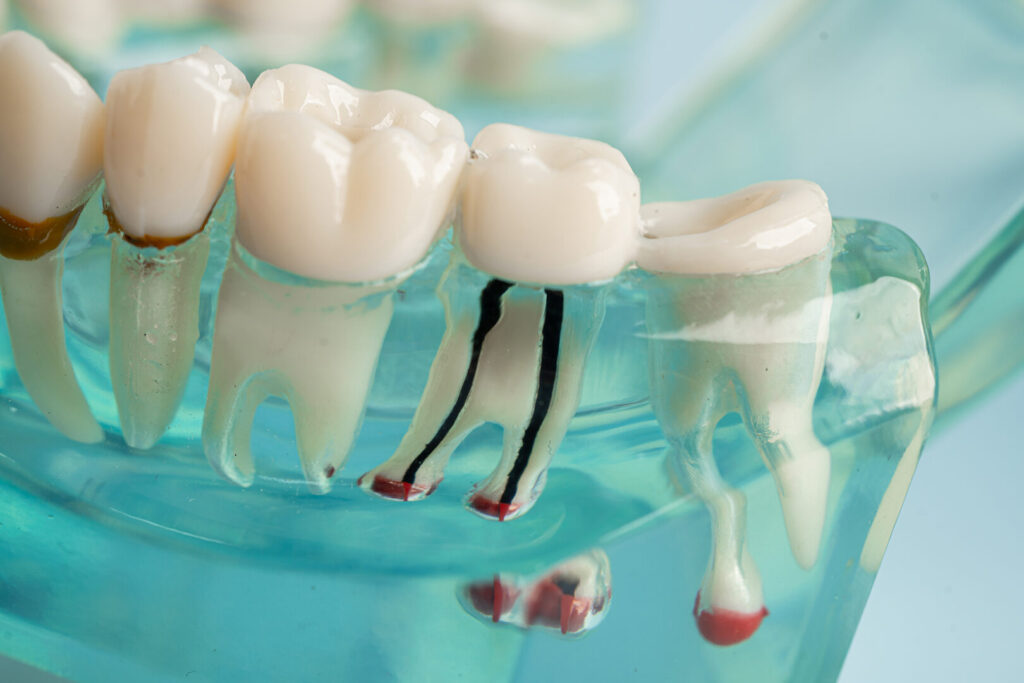 wisdom tooth surgery cost