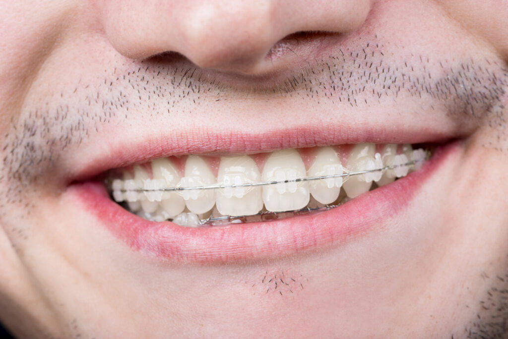 clear braces adults