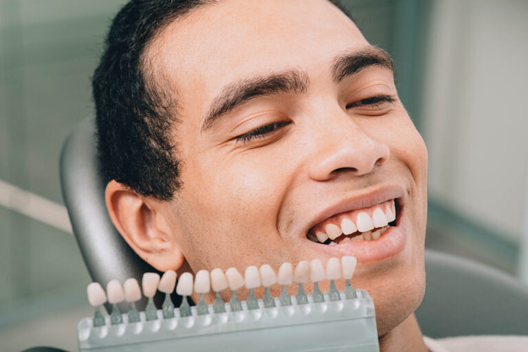 dental veneers