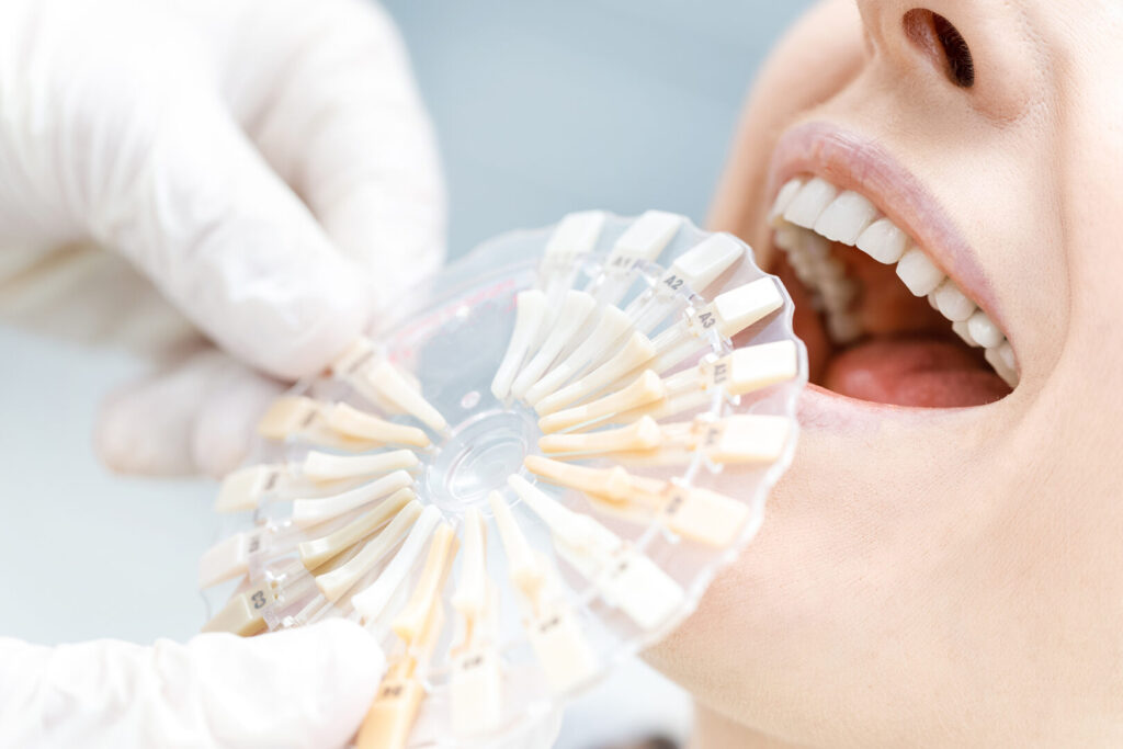 dental veneers Singapore