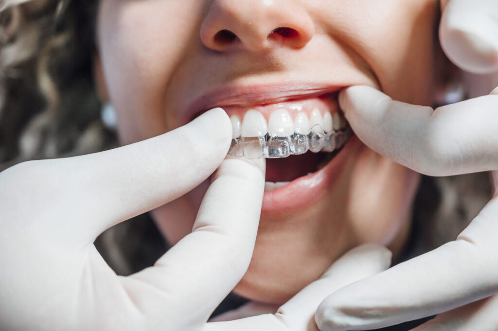 getting clear braces