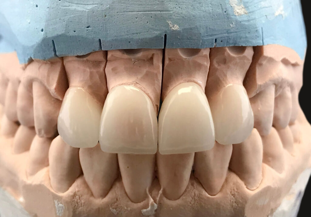 how long do dental veneers last