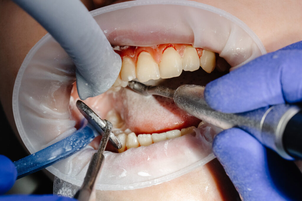 periodontal treatment cost Singapore