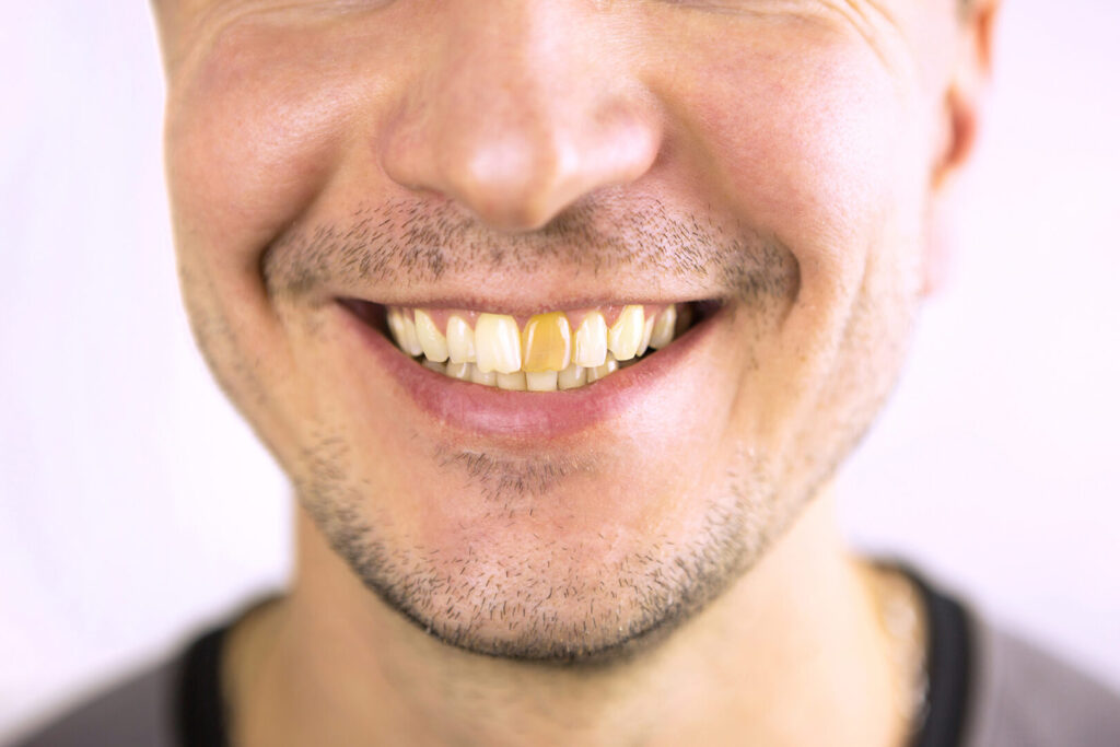 teeth bonding stain removal