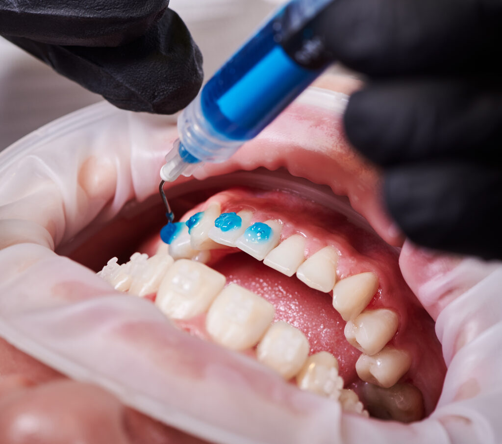 teeth whitening Singapore