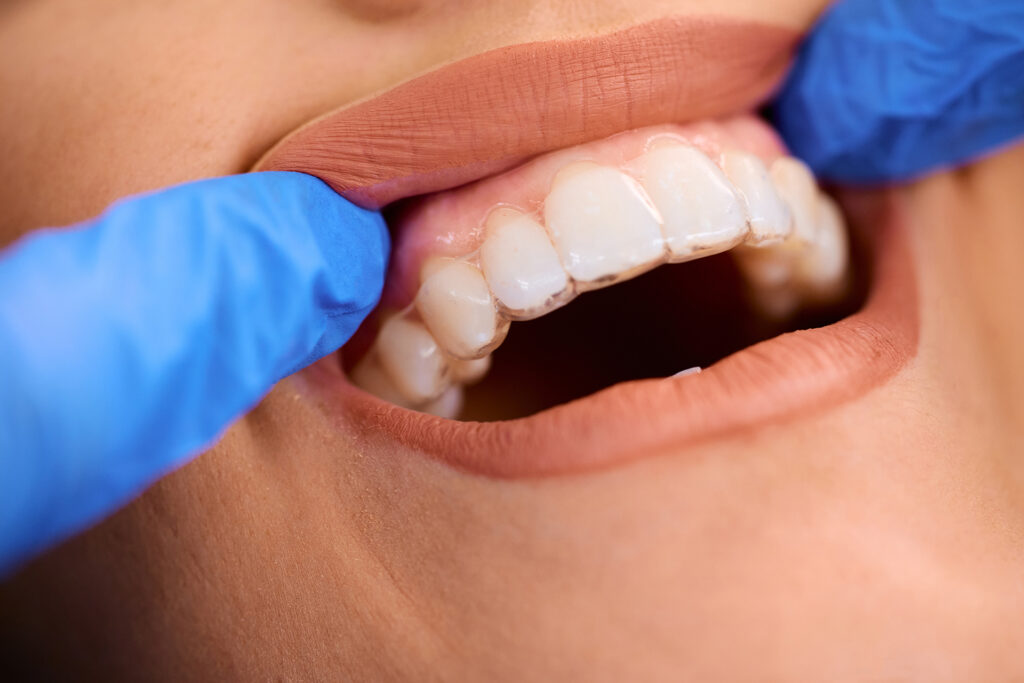 adult orthodontic treatment in Singapore