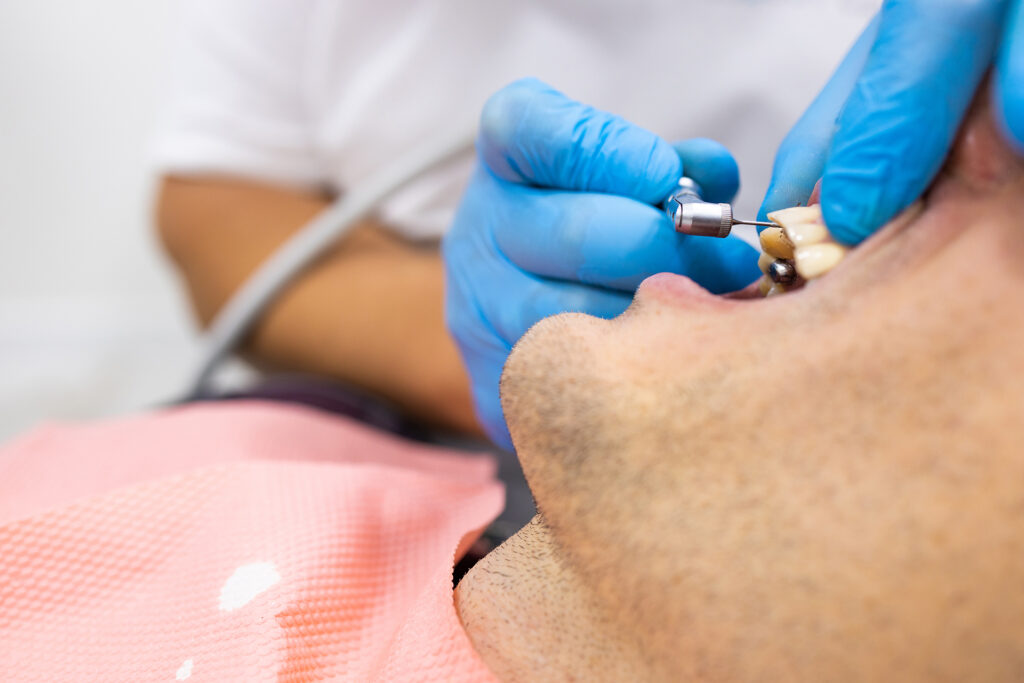 dental filling price in Singapore
