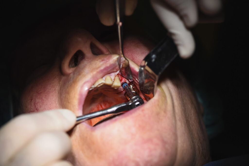how long should pain last after tooth extraction