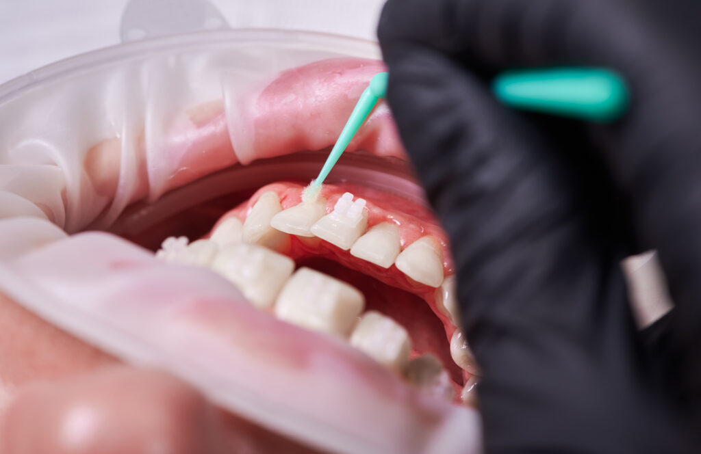 receding gums treatment in Singapore