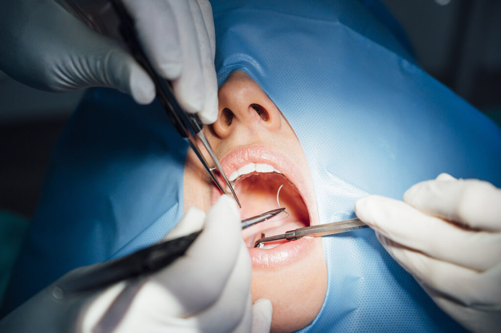 success of root canal treatment