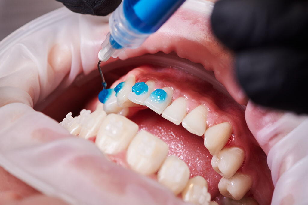 teeth whitening at dentist office