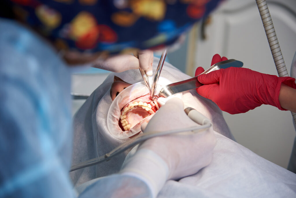tooth extraction cost Singapore