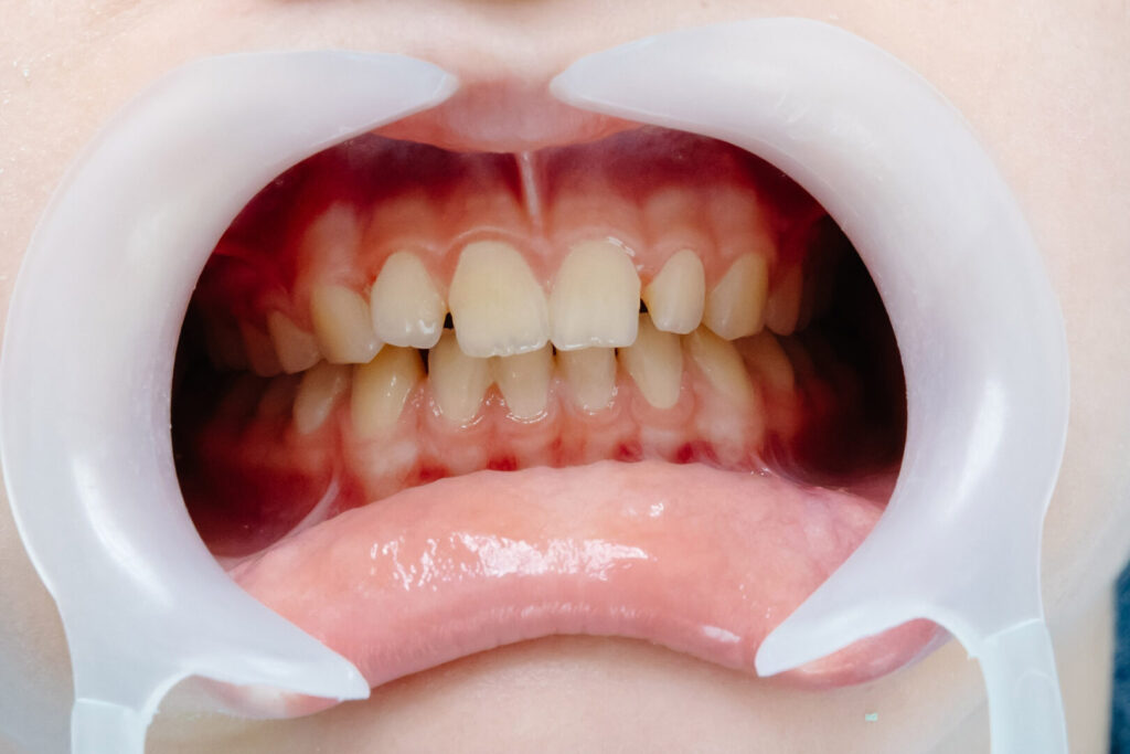 treatment gingival recession