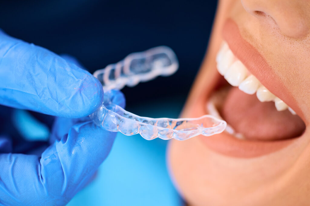braces vs aligners