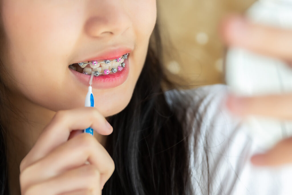 clear aligners vs braces