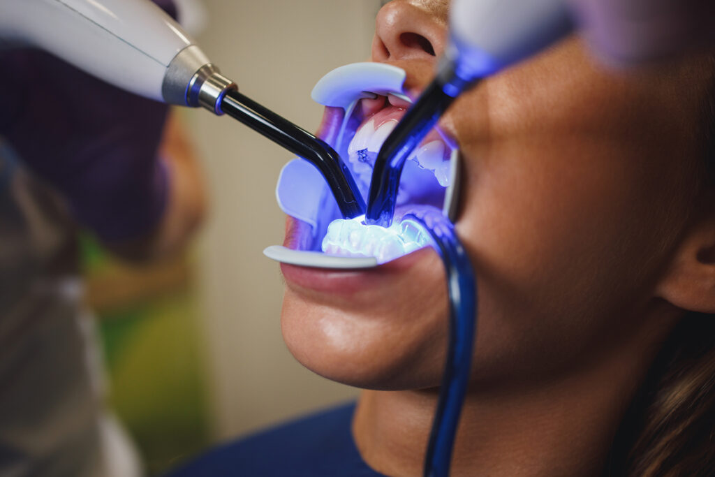 composite bonding teeth procedure