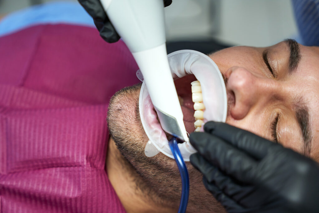 composite bonding teeth price