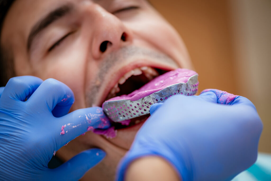 dental crown vs veneer