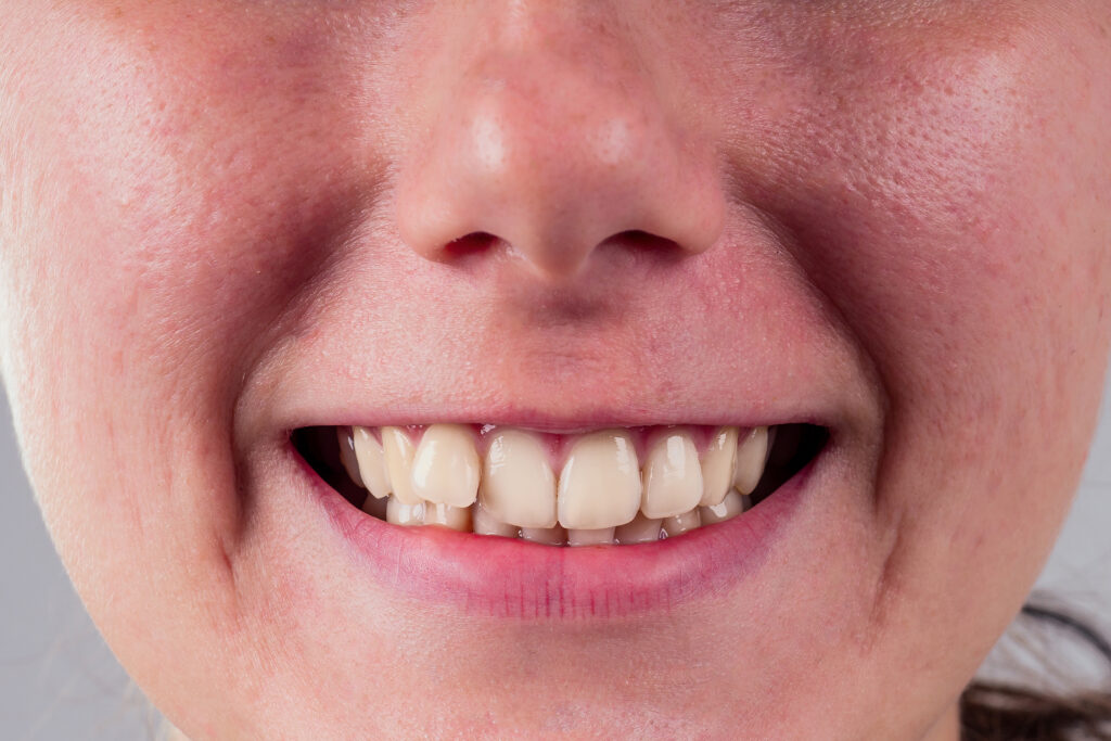 how to stop clenching teeth
