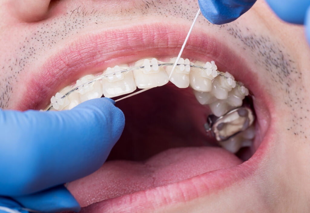 metal braces vs clear aligners