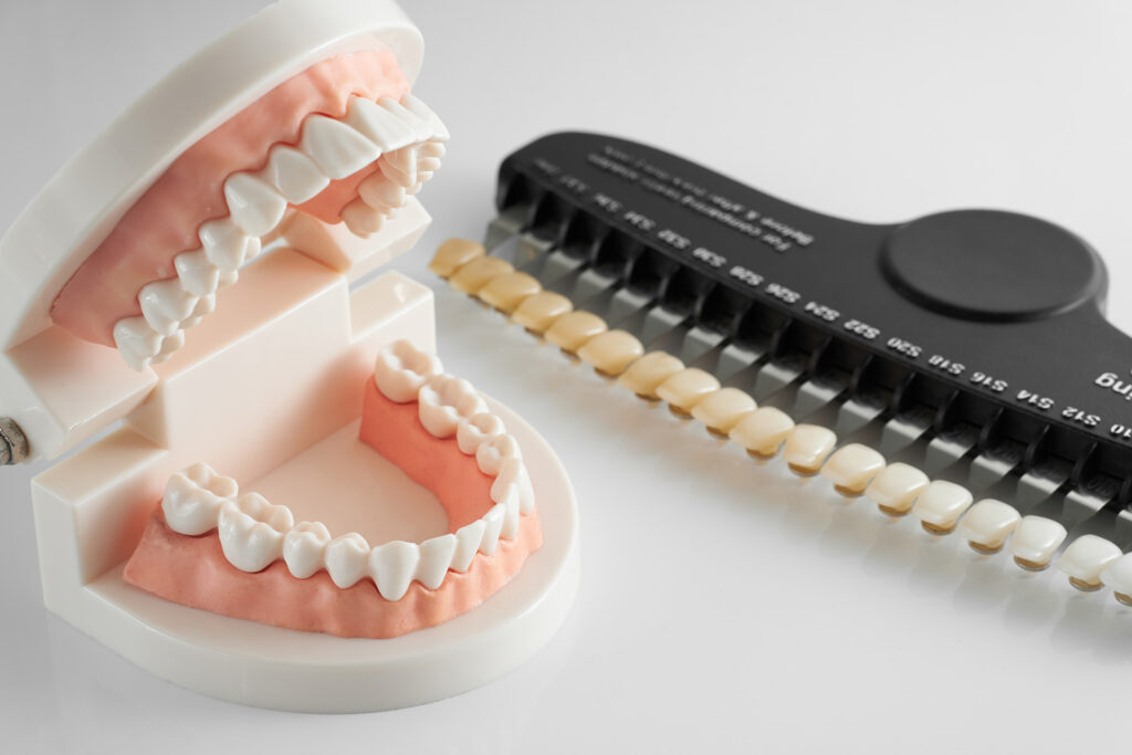 veneers vs crowns