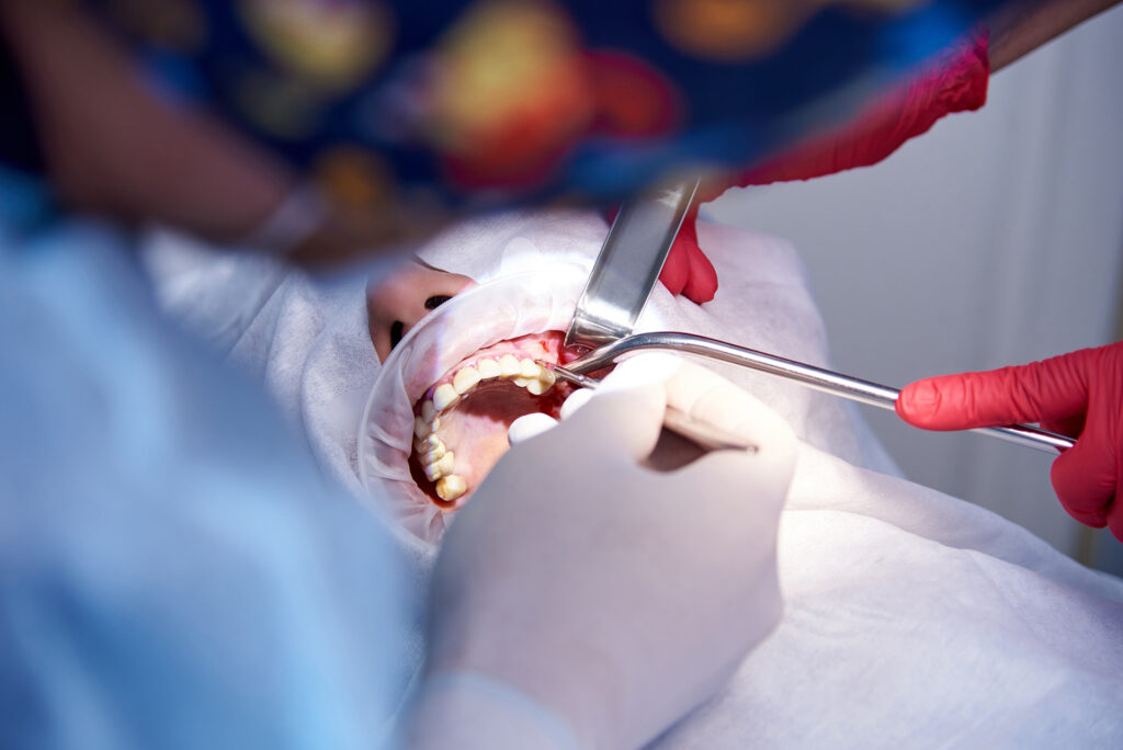 wisdom tooth extraction vs surgery difference
