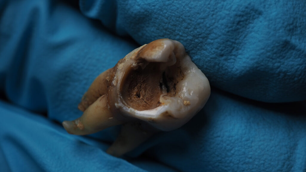 decayed wisdom tooth extraction