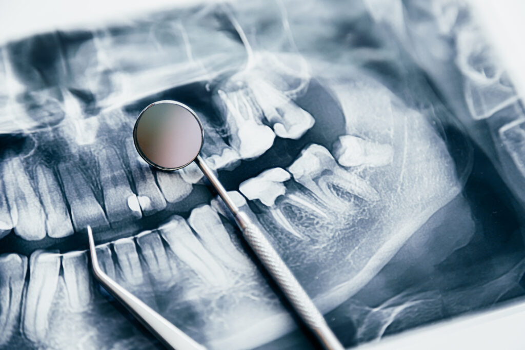 wisdom tooth decay in Singapore